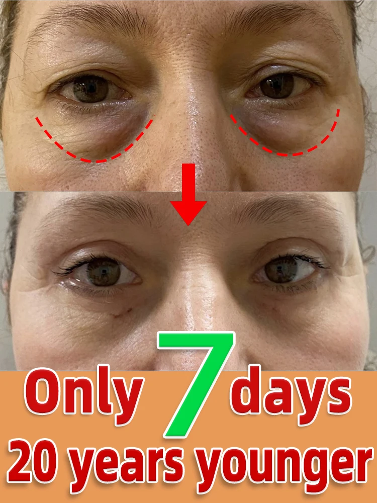 Repairing Problems Around The Eyes