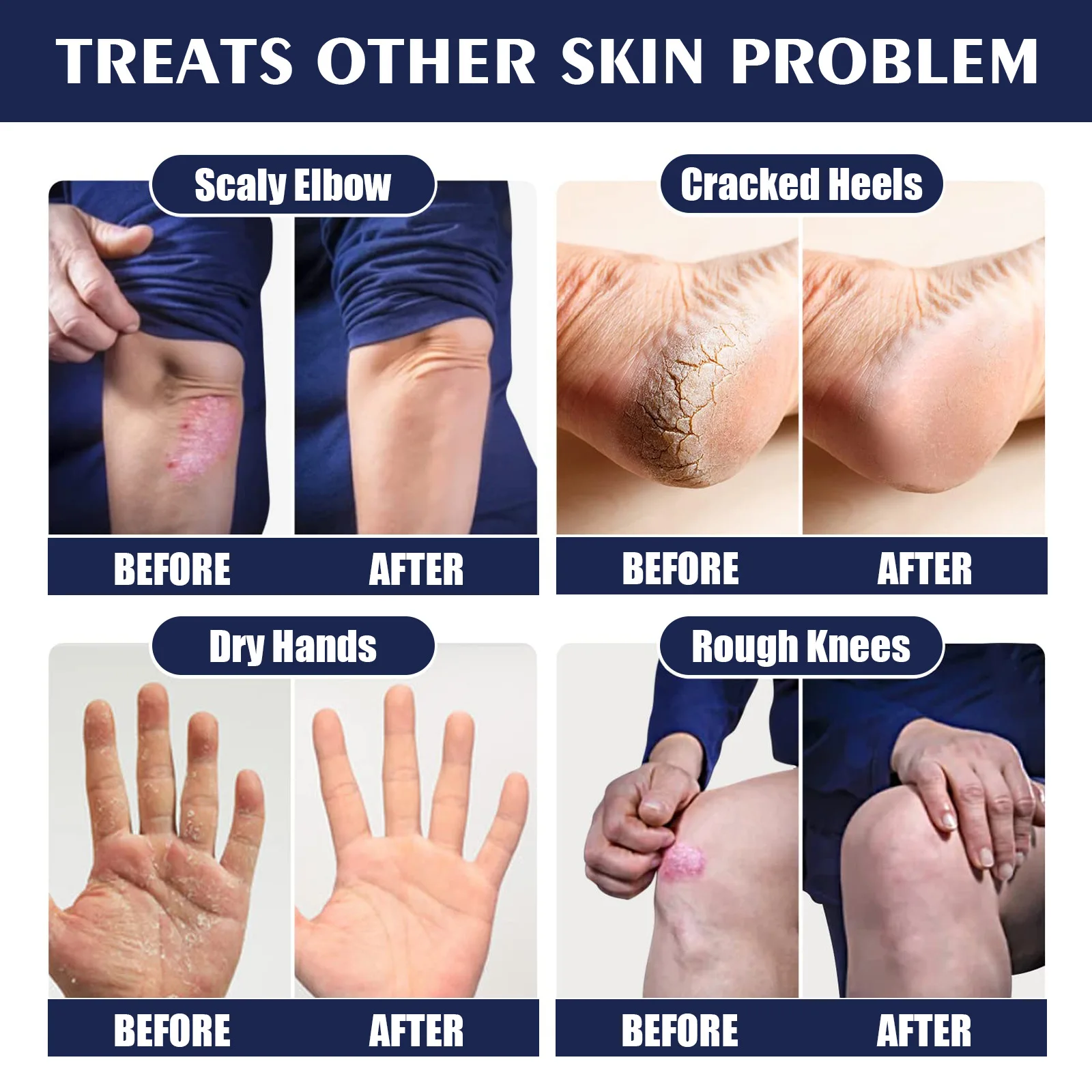 Anti Crack Hand Foot Cream Salto Anti-Secagem Reparação Rachada Máscara de Pés Removedor de Clareamento Hidratante Pele Morta, Produtos para Cuidados com os Pés