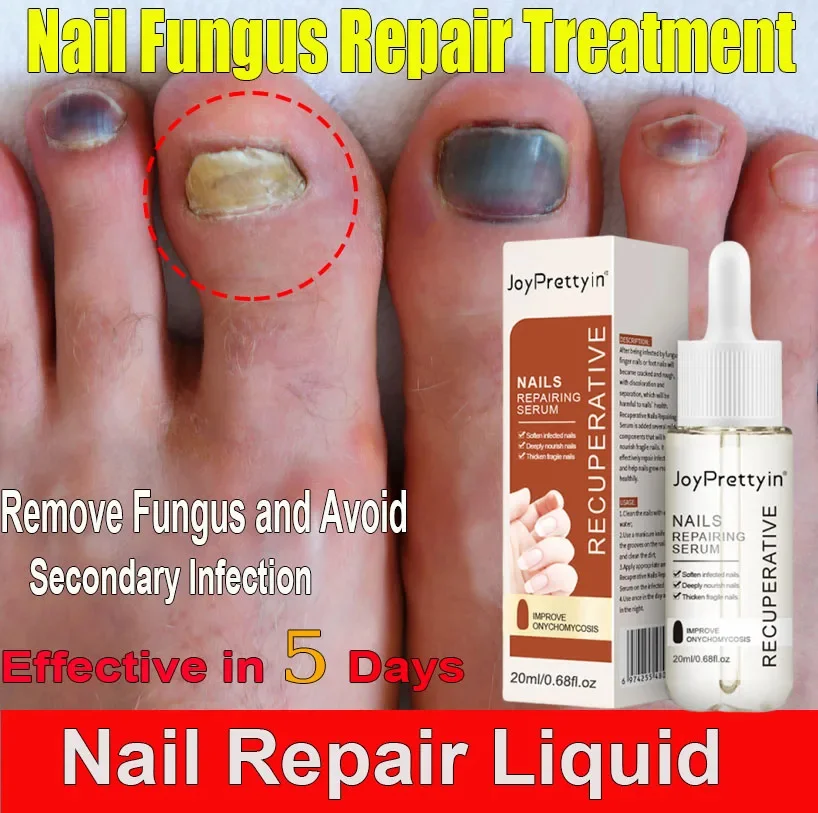 손톱 곰팡이 치료 에센스 손발톱 진균증 제거 손상된 손톱 수리 발가락 감염 방지 젤 발 크림 제거 손톱 곰팡이