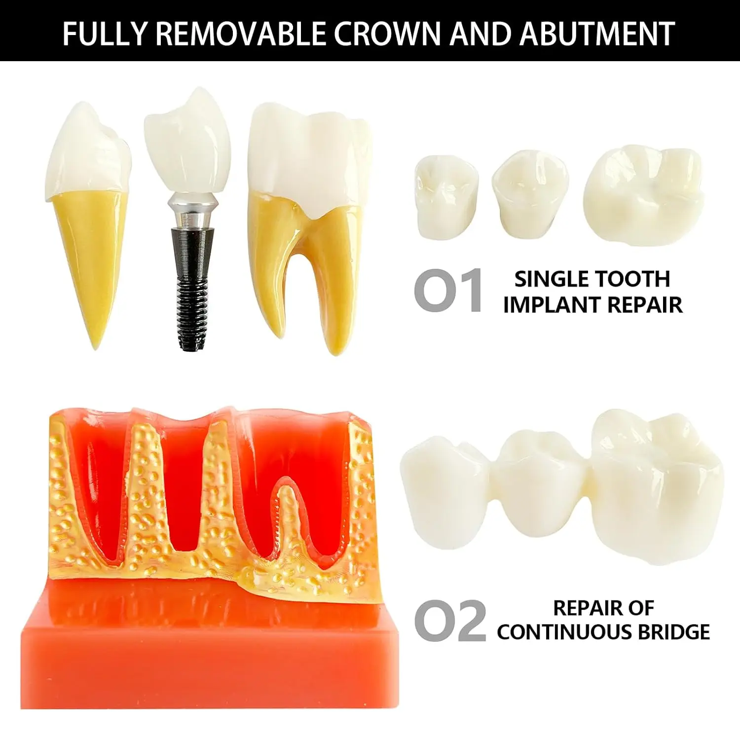 Dental Implant Model with Removable Crown Bridge 4 Times Enlarged Demonstrative Teeth Model Dental Teaching Student Training