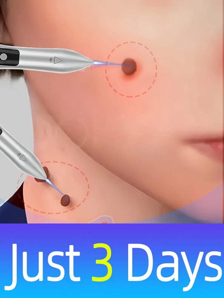 2025 New Products laser pen. solve wart tools.