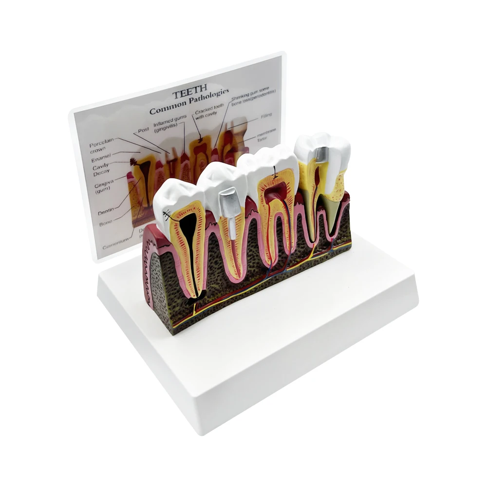 Removable Teeth Anatomy Models Detail Structure Demo Dental Anatomical Models For Clinics Dentist-Patient Communication Teaching