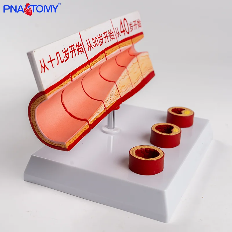

Age Group Large Vessel Model 4 Parts Atherosclerotic Cardiovascular Artery Atherosclerotic Vascular Pathological Model