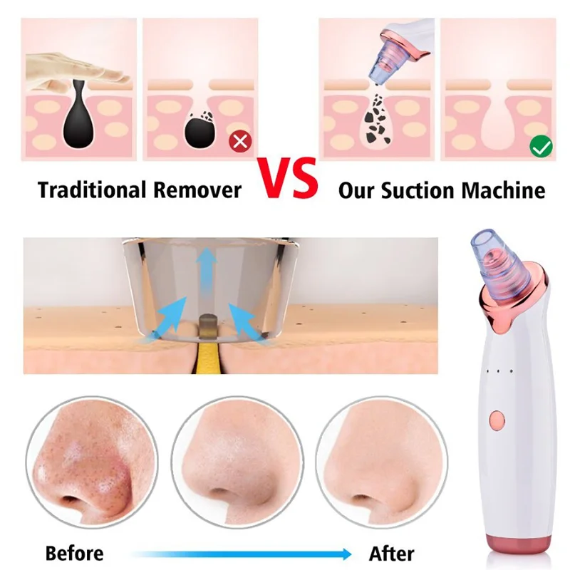 جهاز كهربائي لشفط وإزالة الرؤوس السوداء للعناية بالبشرة والعناية بالوجه ودورة المياه USB منظف عميق للأنف وغسيل الوجه بثرة