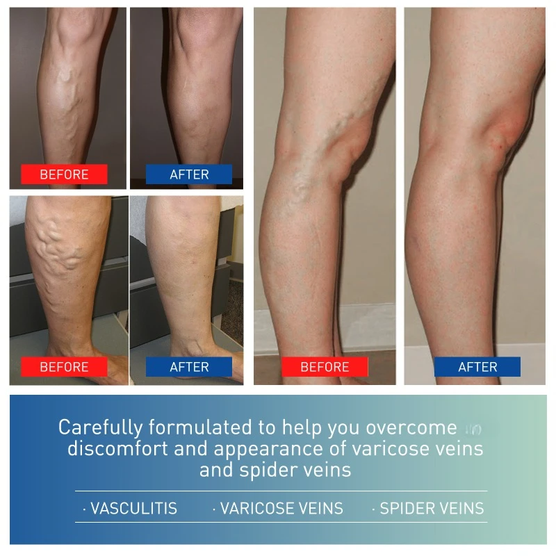 Varicose Vein Repair Cream Tongmai Effective Relieves Leg Bulge Pain Treatment Cream Vasculitis Phlebitis Remove Vein 20g