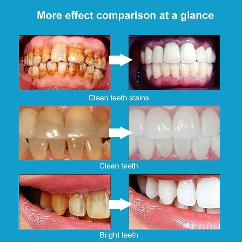 Teeth Whitening Toothpaste Remove Plaque Stain Dental Calculus Fresh Breath Preventing Periodontitis Oral Cleaning Care Tools