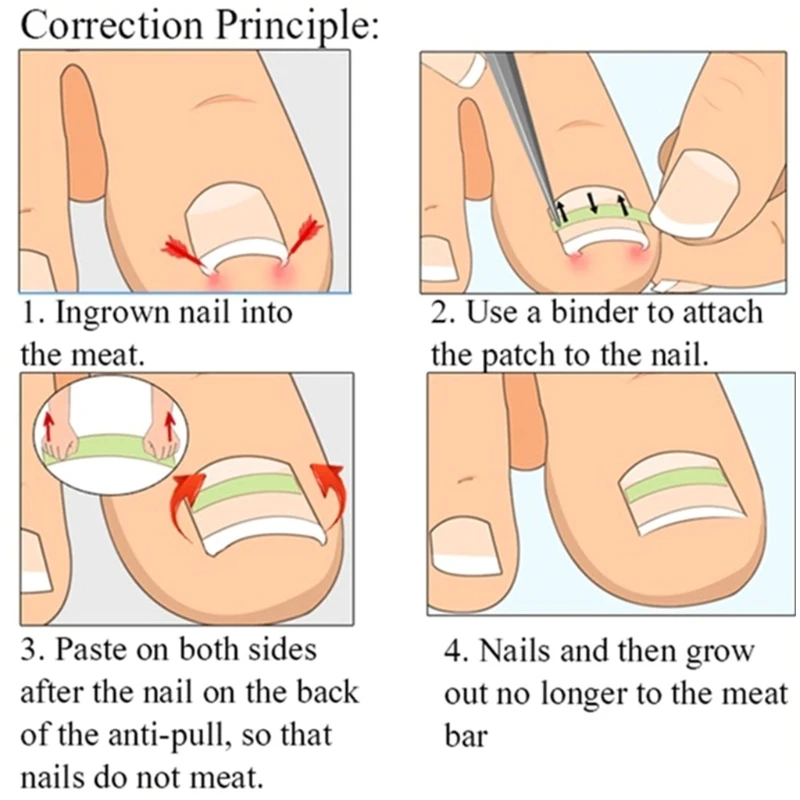 E1YE 10PCS Dispositivo per correzione delle unghie dei cuscinetti per unghie incarnite Pedicure per unghie dei piedi