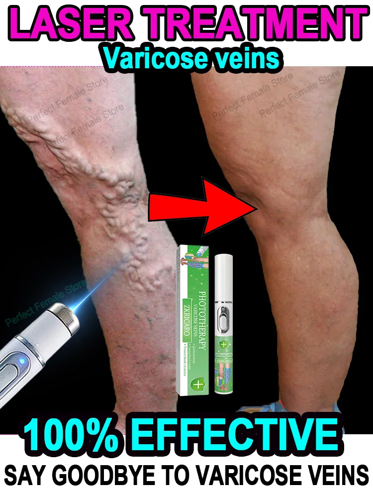 Varicose Veins Products