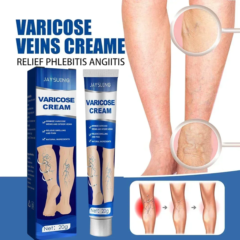 

Effective Relieve Varicose Vein Ointment Get rid of Spider Legs Vasculitis Phlebitis Cream