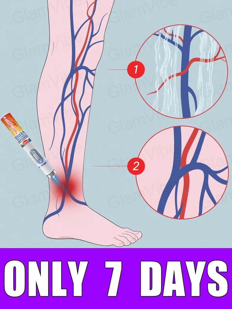 

Generation-2 Laser Says Goodbye To Spider Legs Varicose In 7 Days