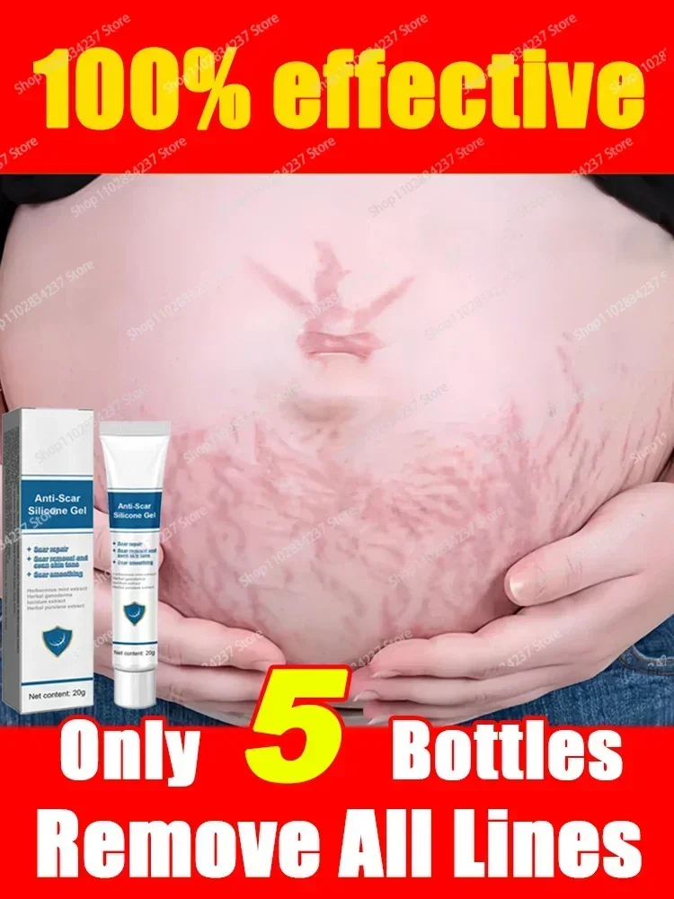 Stretch Mark Removal Cream Permanently Removes Stretch Marks Skin Care