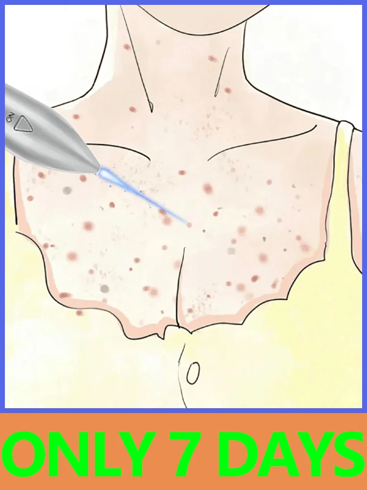 2025 أدوات الليزر المشتركة الجديدة للثآليل الأخمصية. #1