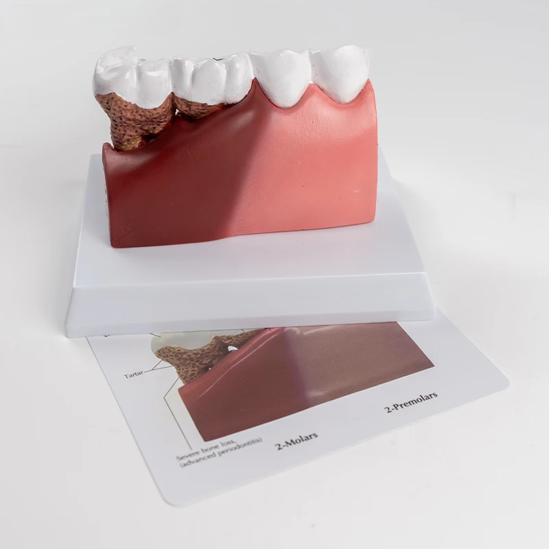 Enlarged tooth decay caries pathological tooth model periodontal nerve anatomy oral teaching model
