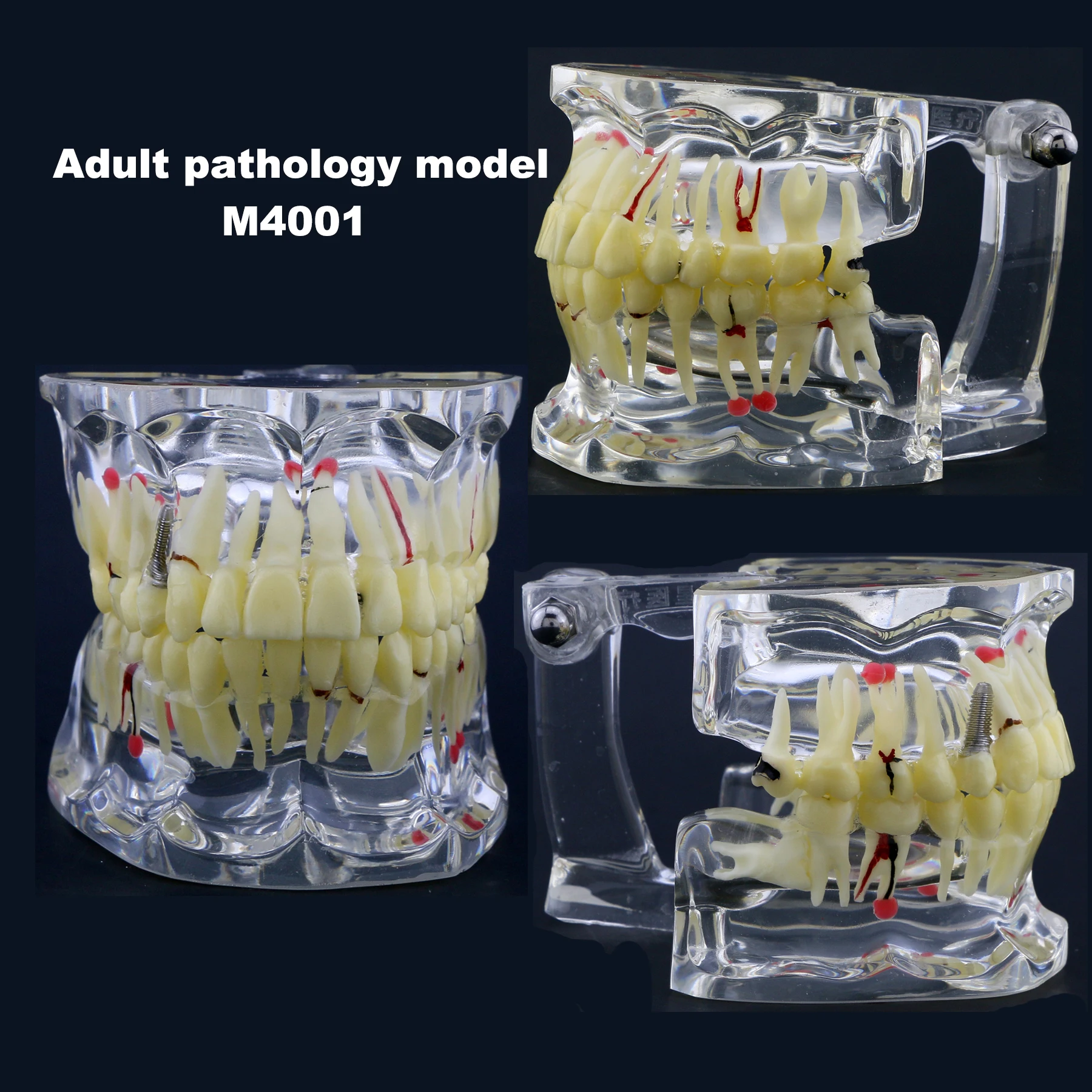 Dental diseases Model Dental Teeth Model Adult pathology model for Dentist Teaching Studying Demo