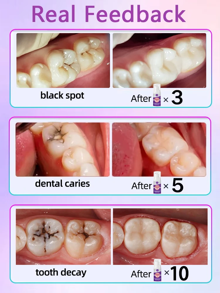 Tratamientos anticaries para caries y caries.