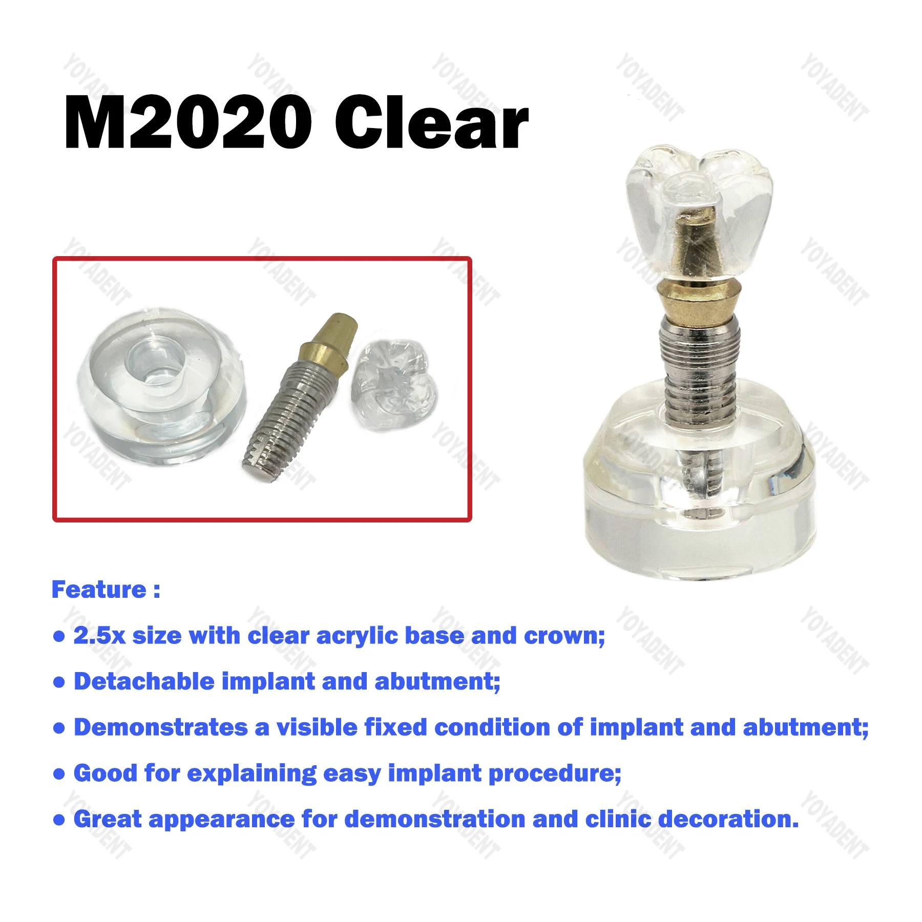 Стоматологическая модель 2,5x размера, модель имплантации зубов, обучающие модели зубов для стоматолога, связь пациента, демонстрационные аксессуары для стоматологии