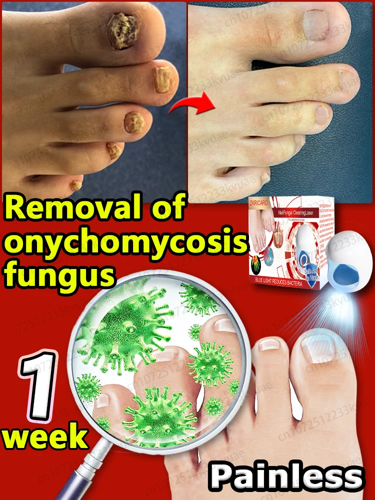 

Produits laser pour l'onychomycose, réparation des problèmes d'ongles