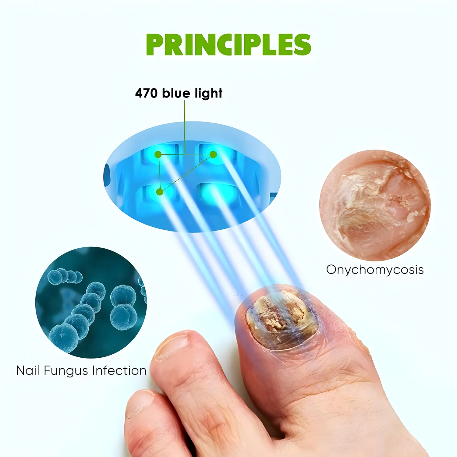 910nm Infrared & 470nm Blue Light Nail Fungus Cleaning Laser Device USB Recharge Onychomycosis Treatment Light Machine