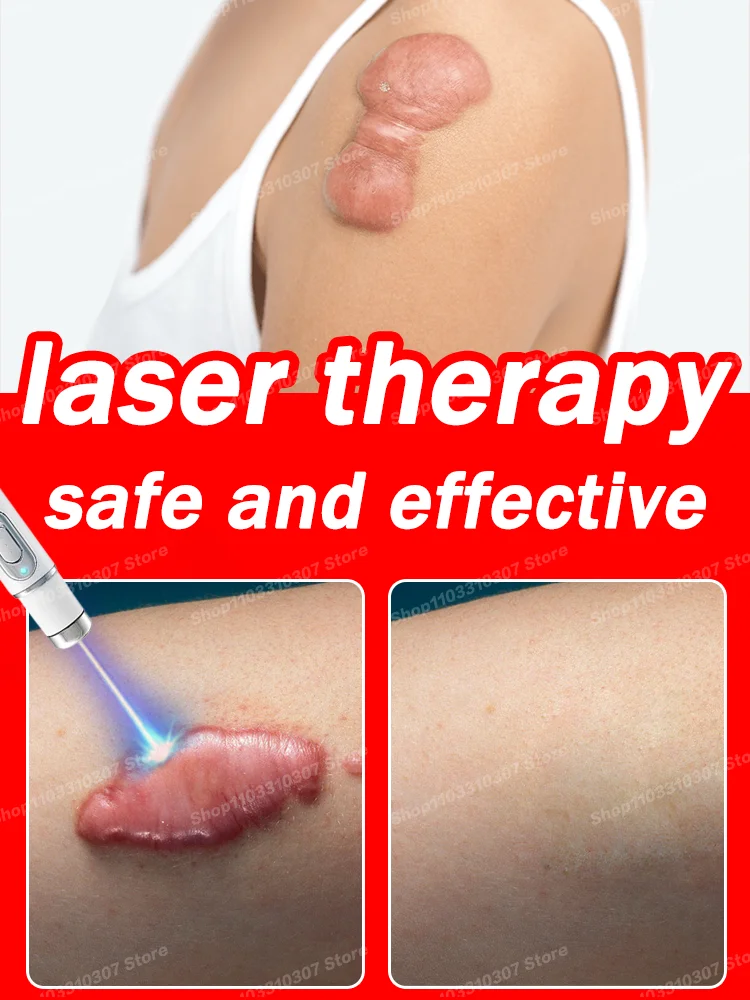 

Laser therapy Keloid scar