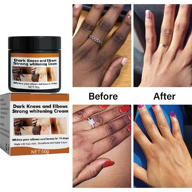 

Dark Knuckles Fast Whitening Cream Pigmentation Correctors For Black Skin Hand Knuckle Elbows Knee Intense Stains Remover Cream