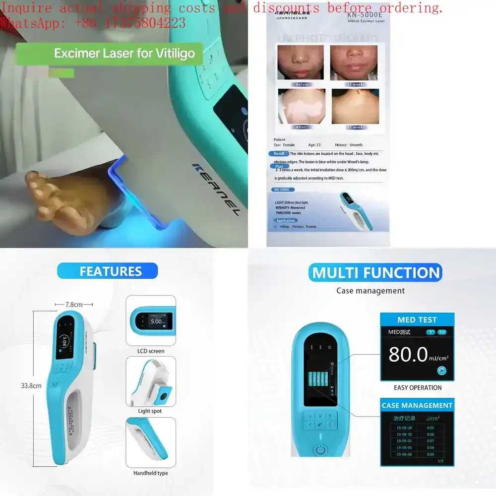 

Kernel Handheld 308 Targeted High Intensity and Precision UV Light for Severe Psoriasis and Vitiligo