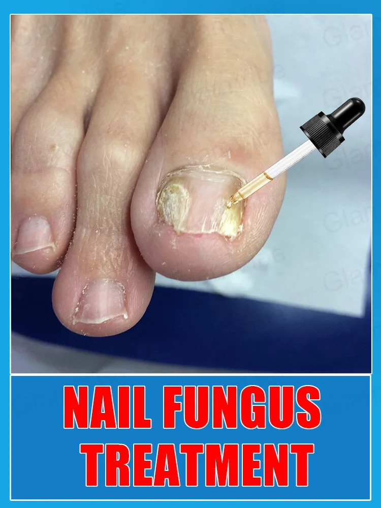 

Iɴsᴛᴀɴᴛ Eғғᴇᴄᴛ! Fᴜɴɢᴀʟ Nᴀɪʟ Essᴇɴᴛɪᴀʟ Oɪʟ, Tᴀʀɢᴇᴛɪɴɢ ᴛʜᴇ Rᴏᴏᴛ ᴏғ Fᴜɴɢᴜs