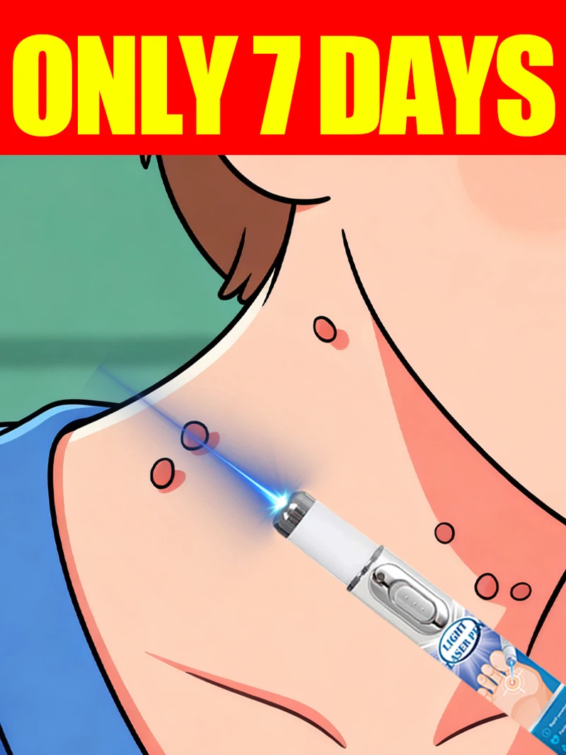 

blue light pen solve warts, hot sale wart care tools