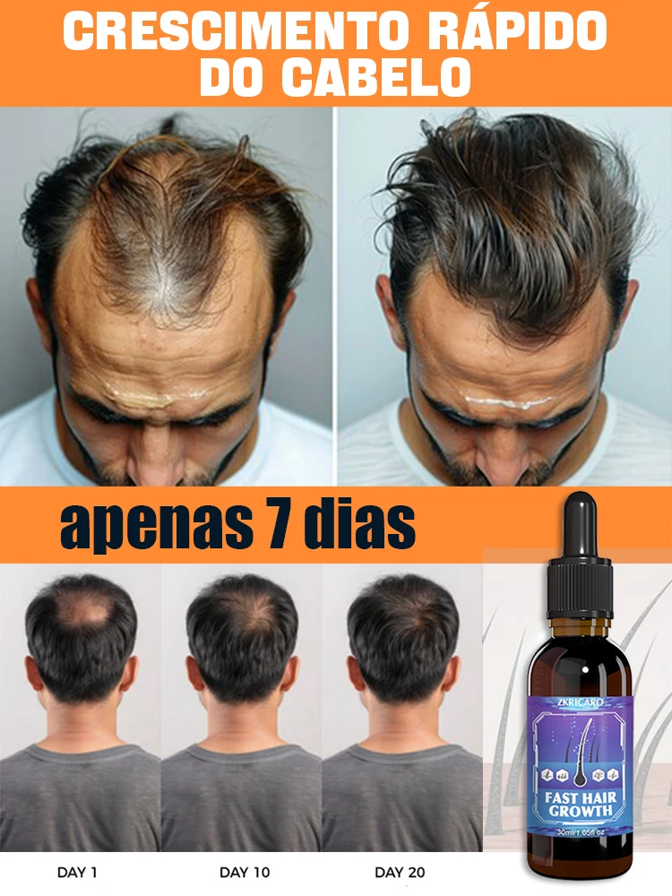 Producto vendedor caliente, 99% de los compradores compran de nuevo, tienen más y más cabello, dios adiós a la calvicie, cabello grueso.