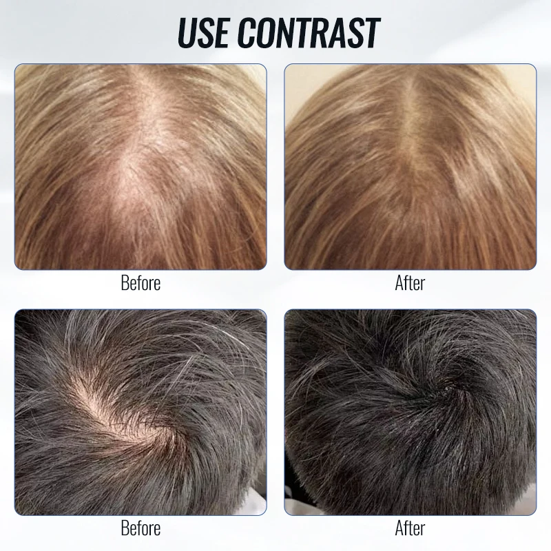 مشط سائل لأداة توزيع فروة الرأس لنمو الشعر، زيت مصل يغذي جذور الشعر الصغيرة المحمولة، مشط تدليك الطب، مدلك رأس الشعر #3