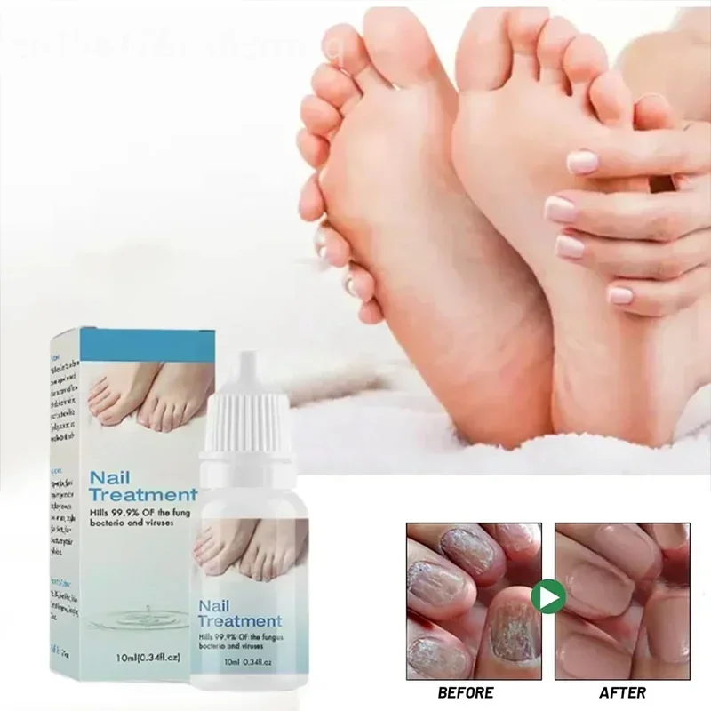 Fungal Nail Oil Foot Repair Essence Toe Nail Fungus Removal Gel Anti Infection Cream Fungal Nail Removal Paronychia