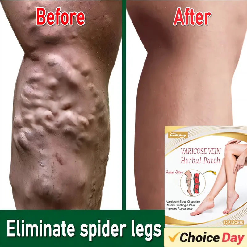 12pcs Varicose Vein Repair Patches Effective Relieves Leg Bulge Pain Treatment Sticker Vasculitis Phlebitis Remove Spider Veins