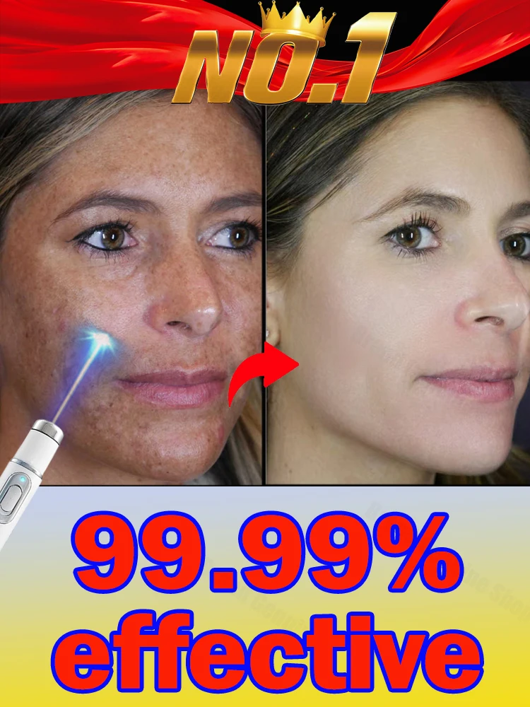 Laser whitening facial spots