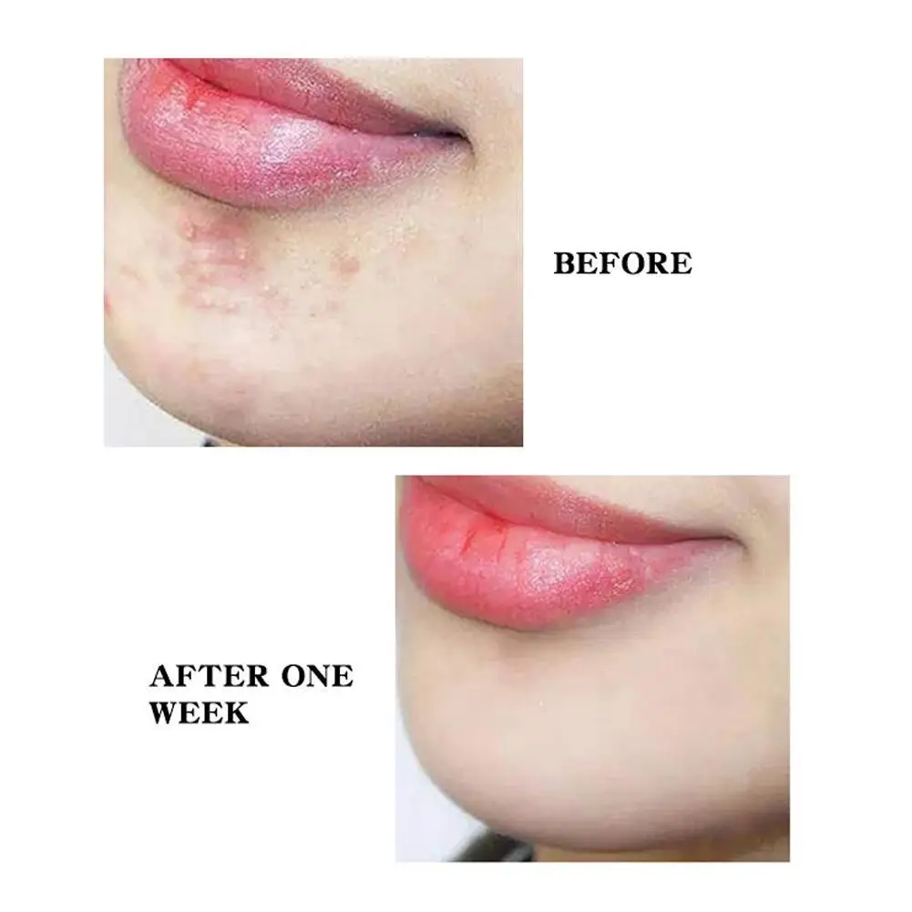 Round Hydrocolloid acne patch Invisible Acne Removal Acne Stickers Cover Face Skin Care Tool