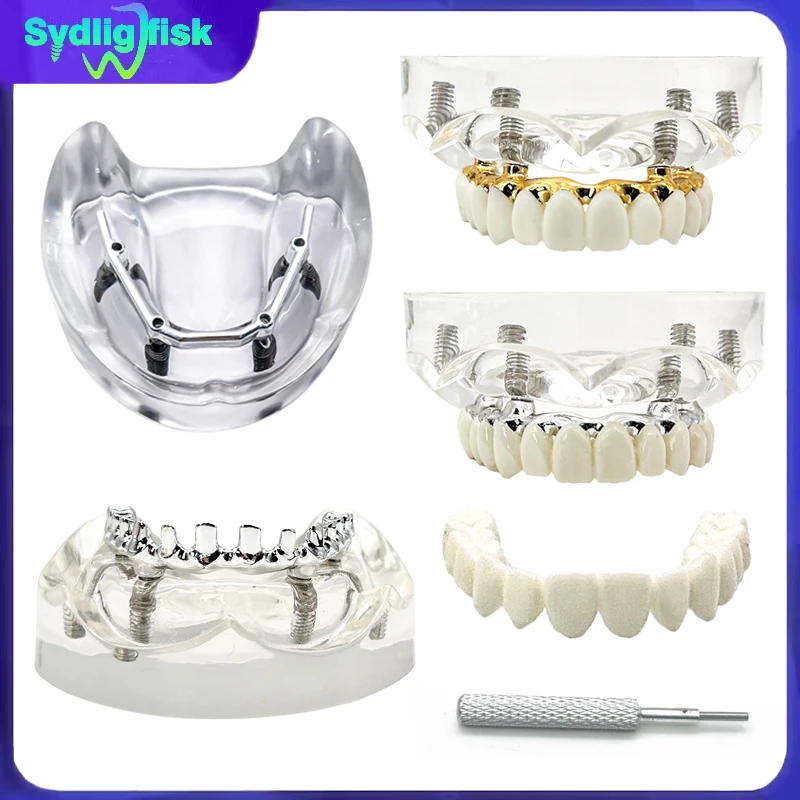 1Pc Dental Implant Model Overdenture Restoration Upper Jaw Removable Teeth Model With 4 Implants for Dentisit Teaching Research