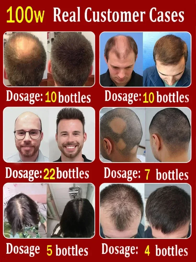 Produit àsuccès,99% des acheteurs achèteront ànouveau,ils ont de plus en plus de cheveux,disent Alfa à la calvitie,cheveux épais