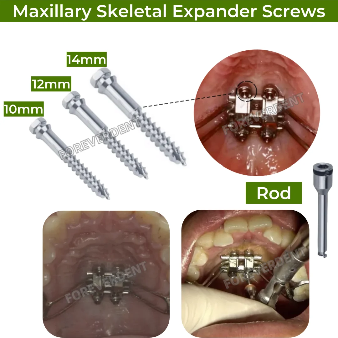 MSE Dental Marpe Palatal Screw Rod Maxillary Skeletal Expander Orthopaedic Mid Facial Parallel Expansion Screw Rod Appliance