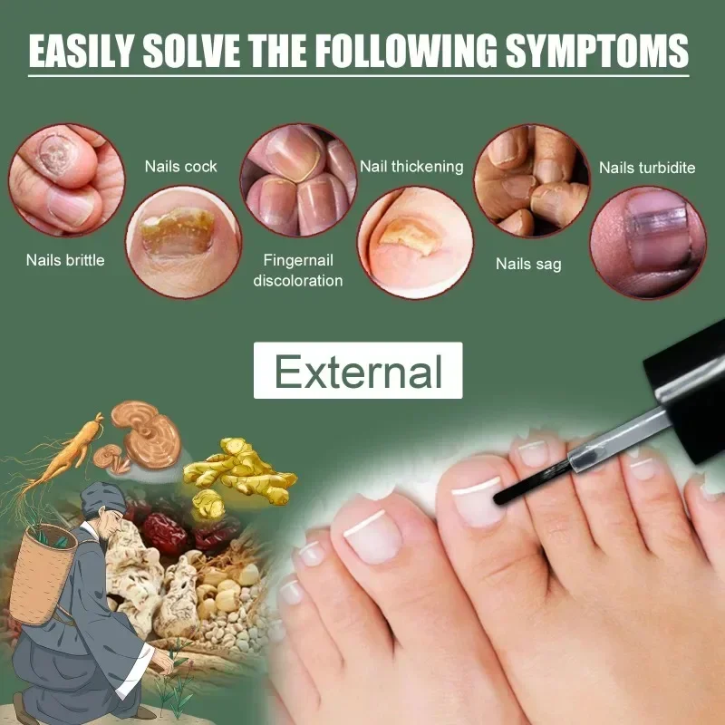 Nail Fungal Treatment Essence Oil Foot Toe Nail Fungus Removal Serum 7 Days Repair Onychomycosi Anti Infection Gel Care Products