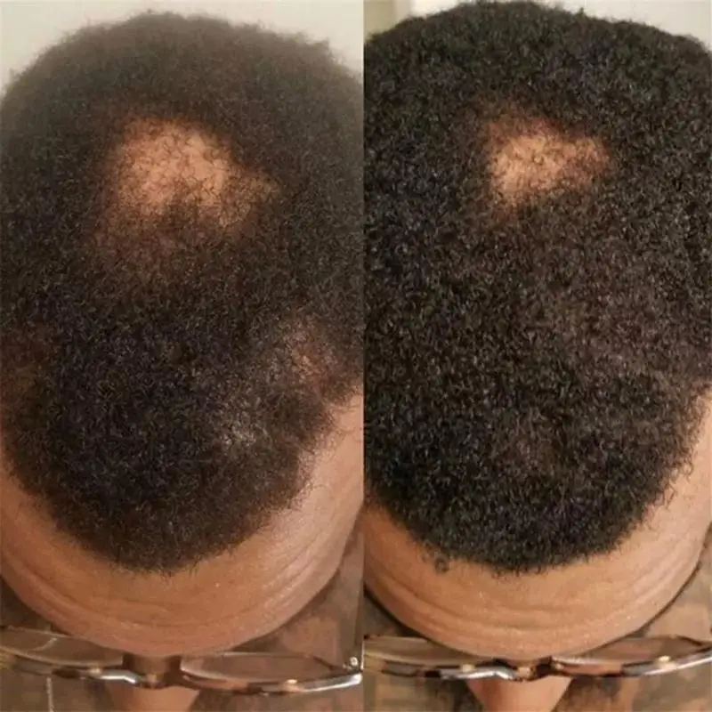 Crescimento do cabelo soro óleo rápido grosso natural cuidados capilares reconstrução do couro cabeludo evitar a perda de cabelo danificado produtos