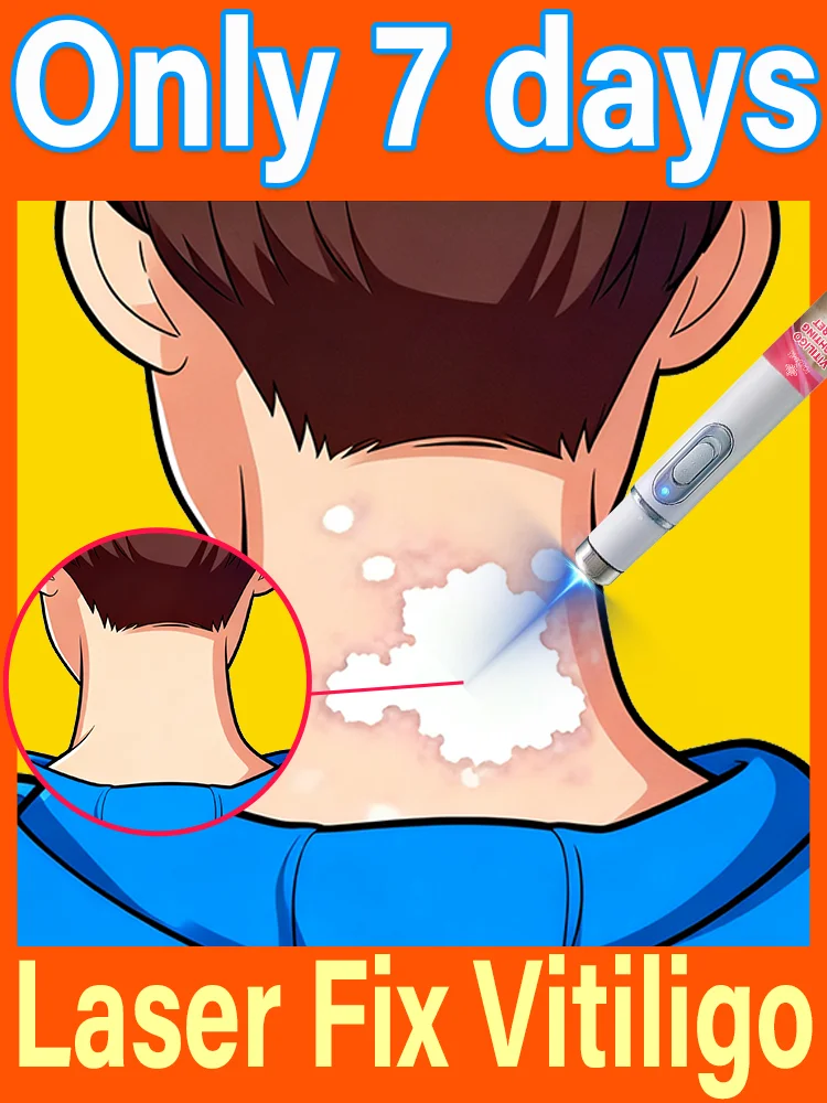 Generation-2 Laser Says Goodbye To Vitiligo In 7 Days