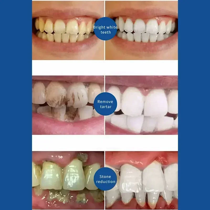 SAF-Réparation Rapide des Caries de Cavités, Élimination de la Plaque, Blanchiment du Jaunissement des Dents, Blanchiment des Dents, 60g, Nouveauté 2023