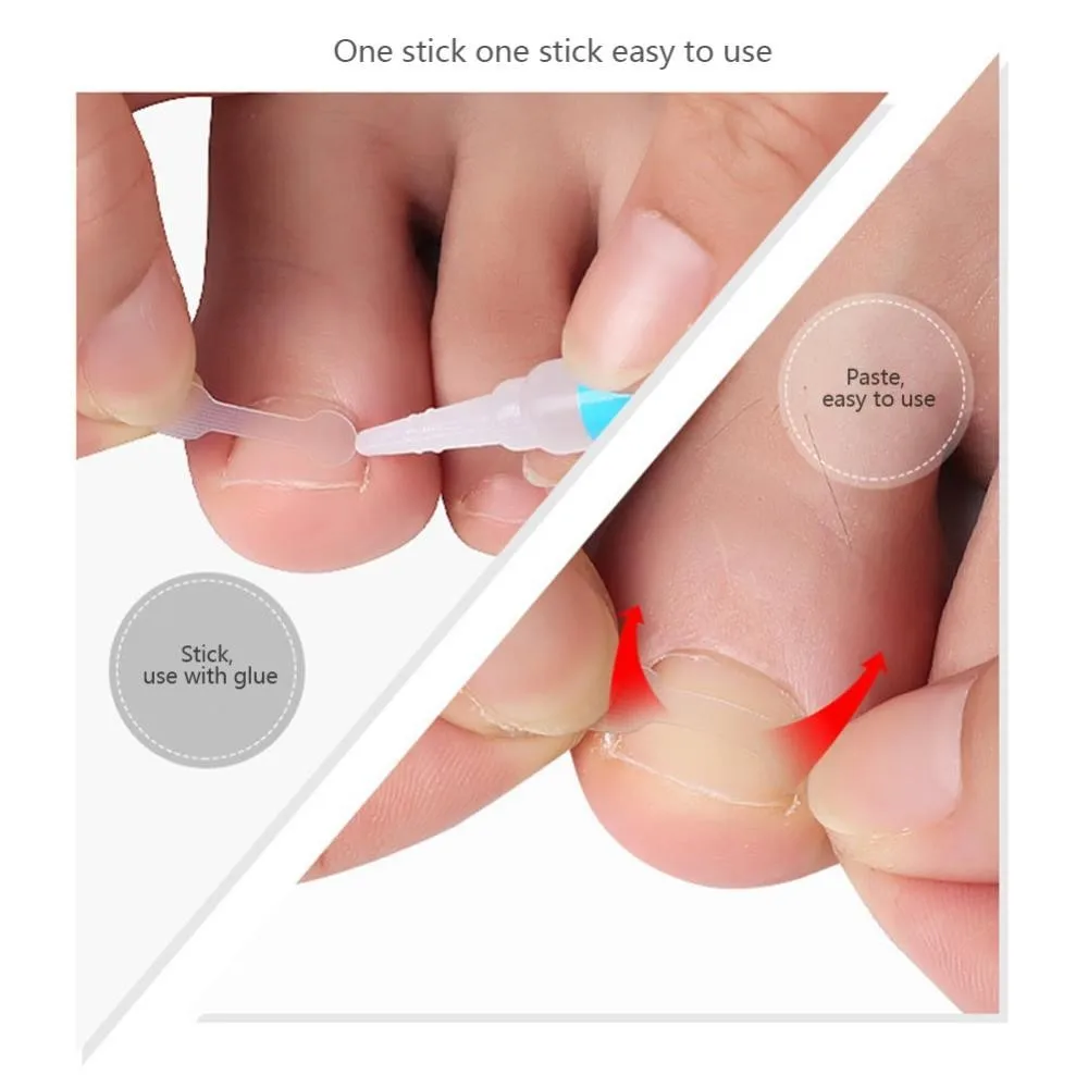 10PCS Ingrown Toe Nail Treatment Ingrown Toenail Correction Tool Elastic Patch Sticker Straightening Clip Brace Pedicure Tools