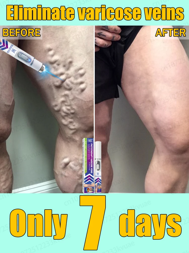 

ᴿᵉᵐᵒᵛᵉ ᵛᵃʳⁱᶜᵒˢᵉ ᵛᵉⁱⁿˢ