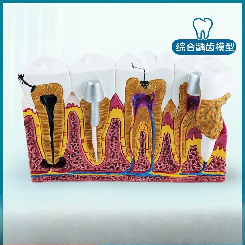 Caries Model Adult Periodontal, Sectional Tooth Model, Pathological Dental Nerve Oral Dentistry Teaching Ornament