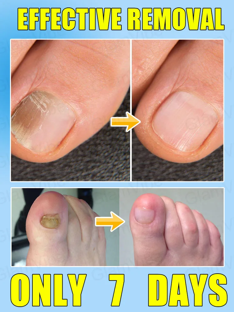 ᴺᵃⁱˡ ᶠᵘⁿᵍᵘˢ ᵗʳᵉᵃᵗᵐᵉⁿᵗ ˢᵖʳᵃʸ⸴ ʳᵉᵖᵃⁱʳ ᵒⁿʸᶜʰᵒᵐʸᶜᵒˢⁱˢ ⁱⁿ ⁷ ᵈᵃʸˢ