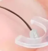 陥入爪矯正ツール 陥入爪治療用弾性パッチステッカー 矯正クリップブレース ペディキュアツール