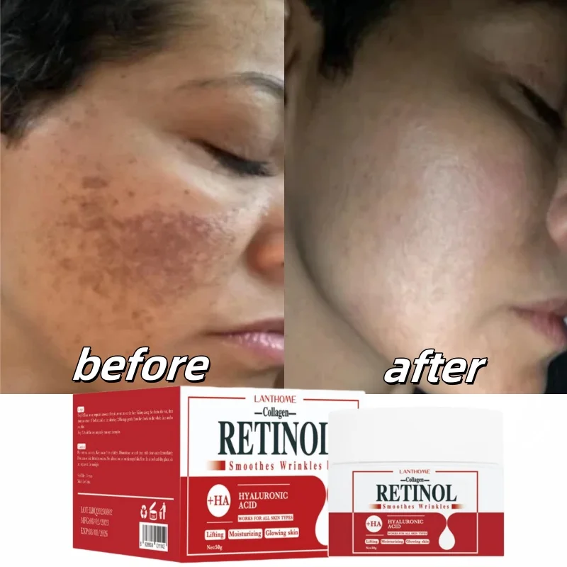 Face Body Whitening Cream Retinol Collagen Hyaluronic Acid 3in1 Remove Dark Spots Eliminate Melanin Dispel Acne Lighten The Skin