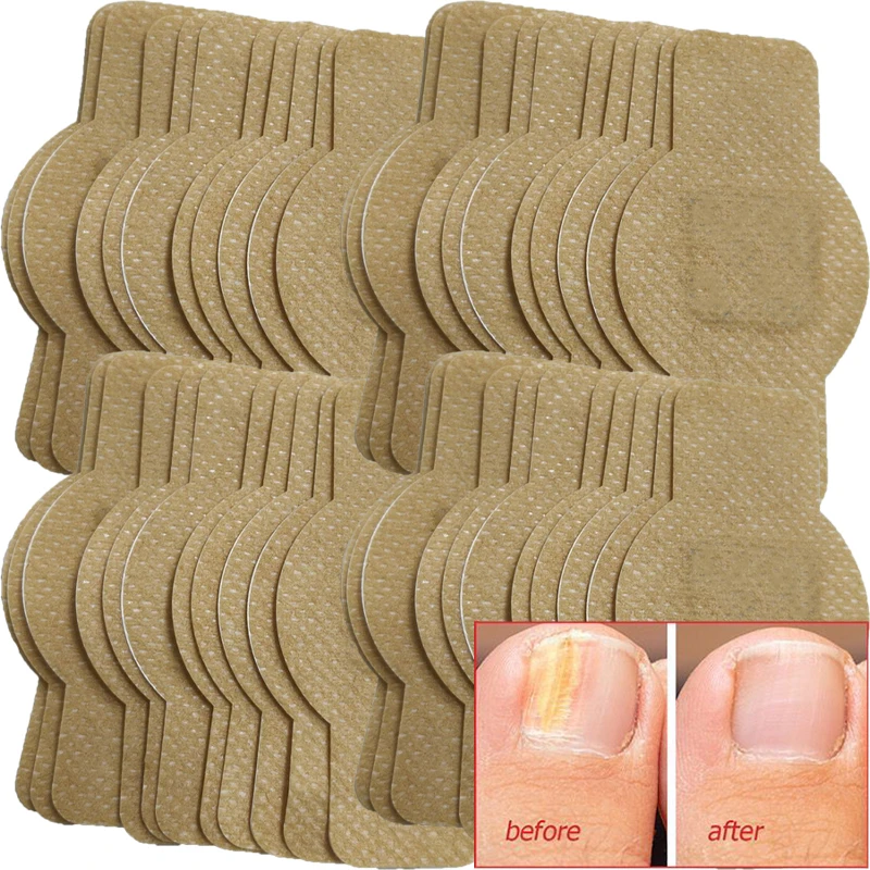 21/105 pçs prego fungo remendo tratamento de fungos da unha adesivos à prova dwaterproof água correção encravada danificado cinza unhas pés cuidados ferramenta