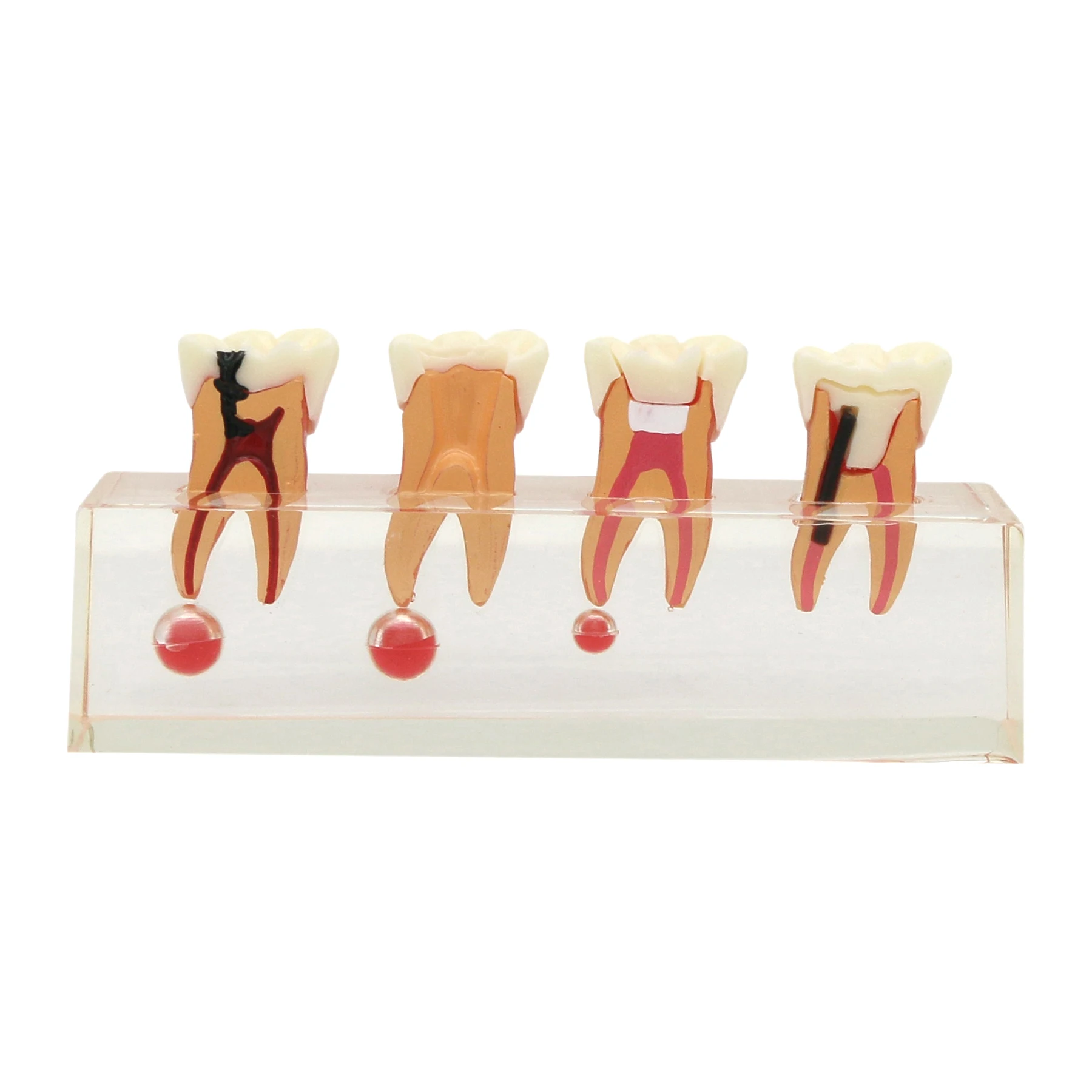 

Dental Model 4-Stages Endodontic Pathological Treatment Model Root Canal Anatomy Demonstration Dentistry Teaching Tooth Model