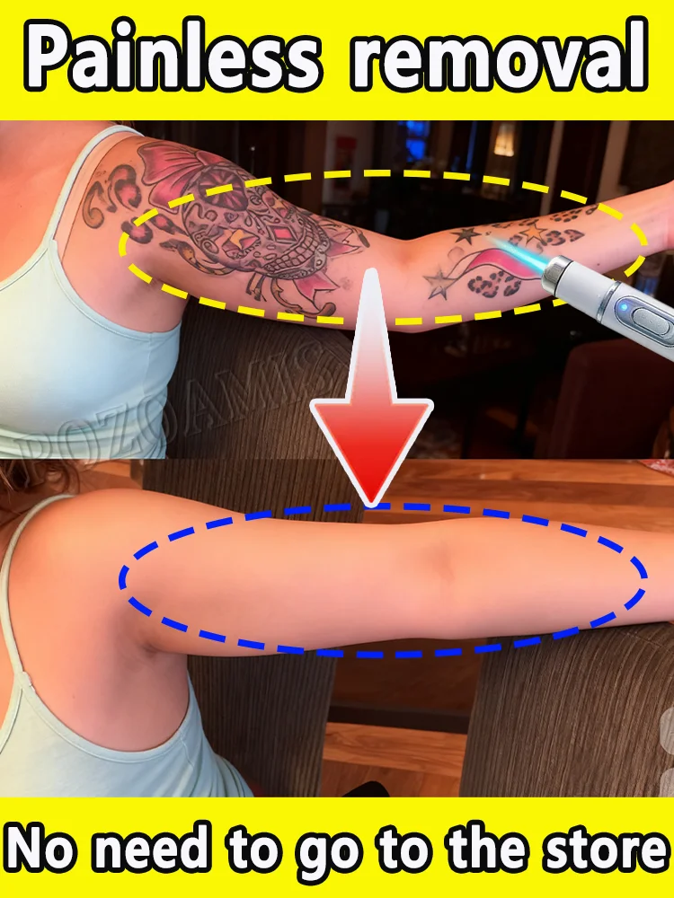 

Удаляет большие и маленькие татуировки, не оставляют шрамы.