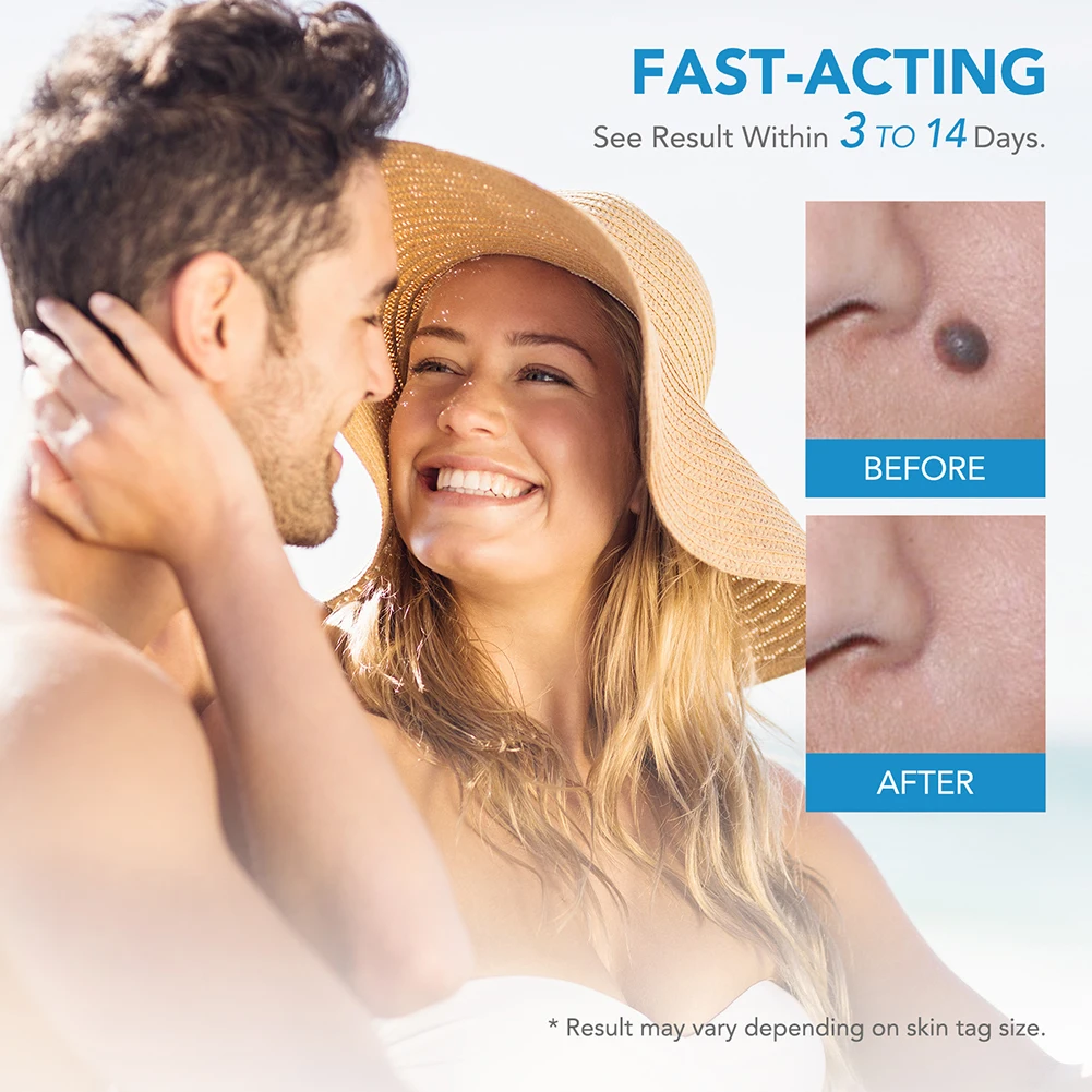 Rubber Rings Skin Tag Removal Device Face Beauty Accessories Remove Skin Wart Kits Multipurpose Supplies for Face Neck Chin Back view 6